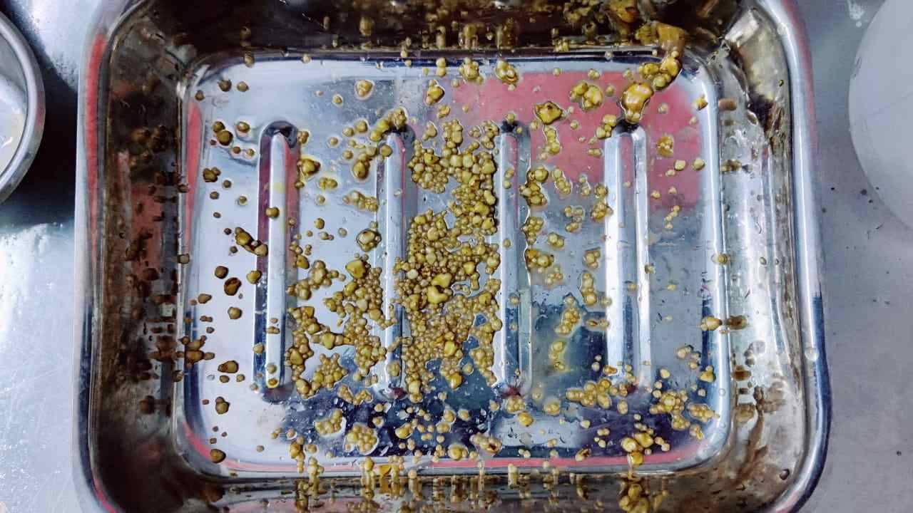 Medical Operation: এক-দুটো করে পিত্তাশয় থেকে বের হল ১,৪৪০ টি পাথর, স্তম্ভিত চিকিৎসক!