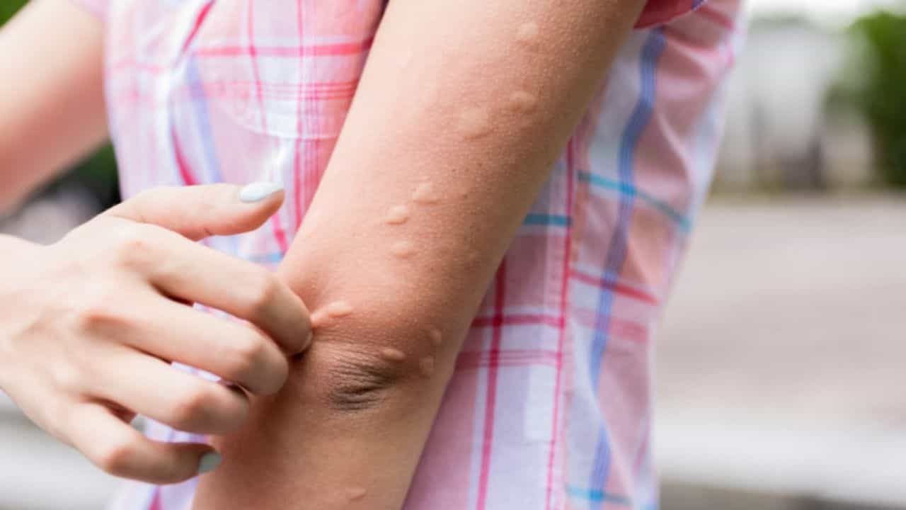 Rid Of Hives: আমবাতের সমস্যায় জেরবার! ত্বকের এই সমস্যা থেকে মুক্তি পান এই ৪ প্রাকৃতিক উপায়ে Rid Of Hives: আমবাতের সমস্যায় জেরবার! ত্বকের এই সমস্যা থেকে মুক্তি পান এই ৪ প্রাকৃতিক উপায়ে