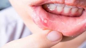 Home Remedies: মুখের আলসার থেকে আরাম পেতে বেছে নিন ঘরোয়া প্রতিকারকে Home Remedies: মুখের আলসার থেকে আরাম পেতে বেছে নিন ঘরোয়া প্রতিকারকে