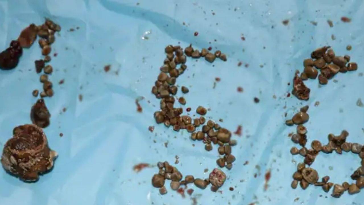 Kidney Stone operation: কিডনিতে ১৫৬ টি পাথর! অস্ত্রপ্রচার করে বের করলেন চিকিৎসকরা