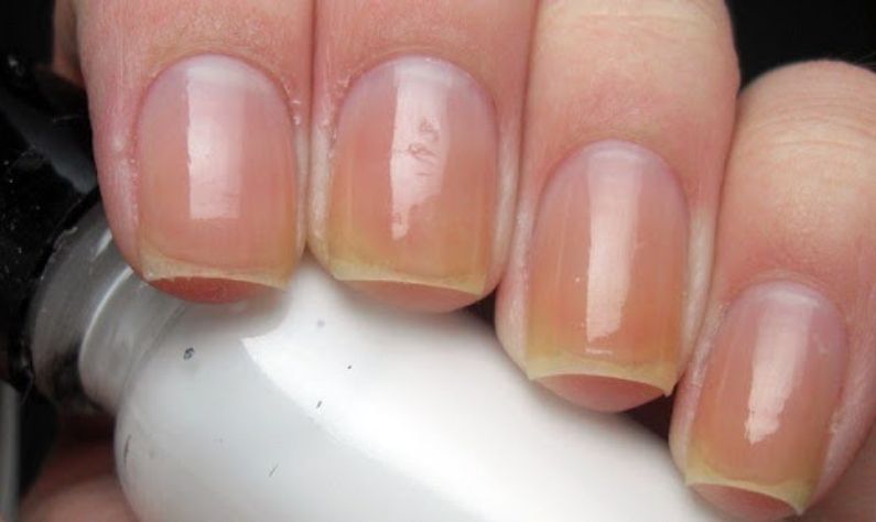 Yellow Nail: Frequent use of nail polish has turned nails yellow? Here are  some homemade tips How to treat nails that get yellow after overusing nail  paint | PiPa News