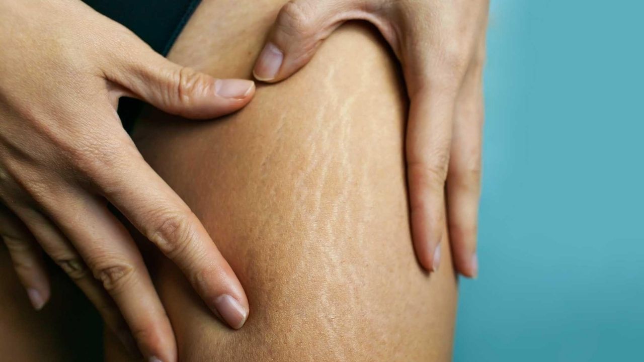 Stretch Mark Removal: শরীরের যাবতীয় স্ট্রেচ মার্ক দূর করতে এই একটি উপাদানই যথেষ্ট, বাড়িতে তা কীভাবে বানাবেন জেনে নিন...