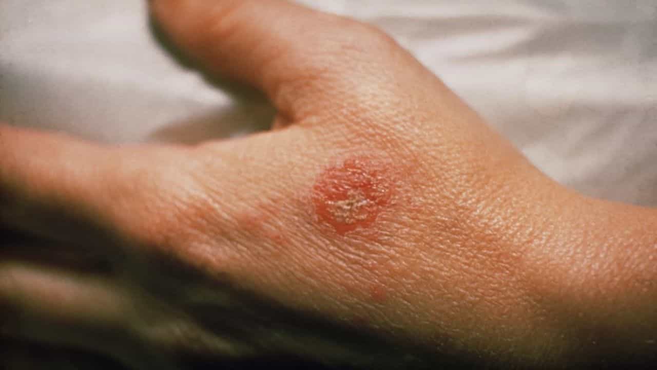 Skin Diseases: কিছু কিছু চর্মরোগ আছে যেগুলো দেখে বিশেষজ্ঞরা বলছেন করোনার লক্ষণ, সেগুলো কী?