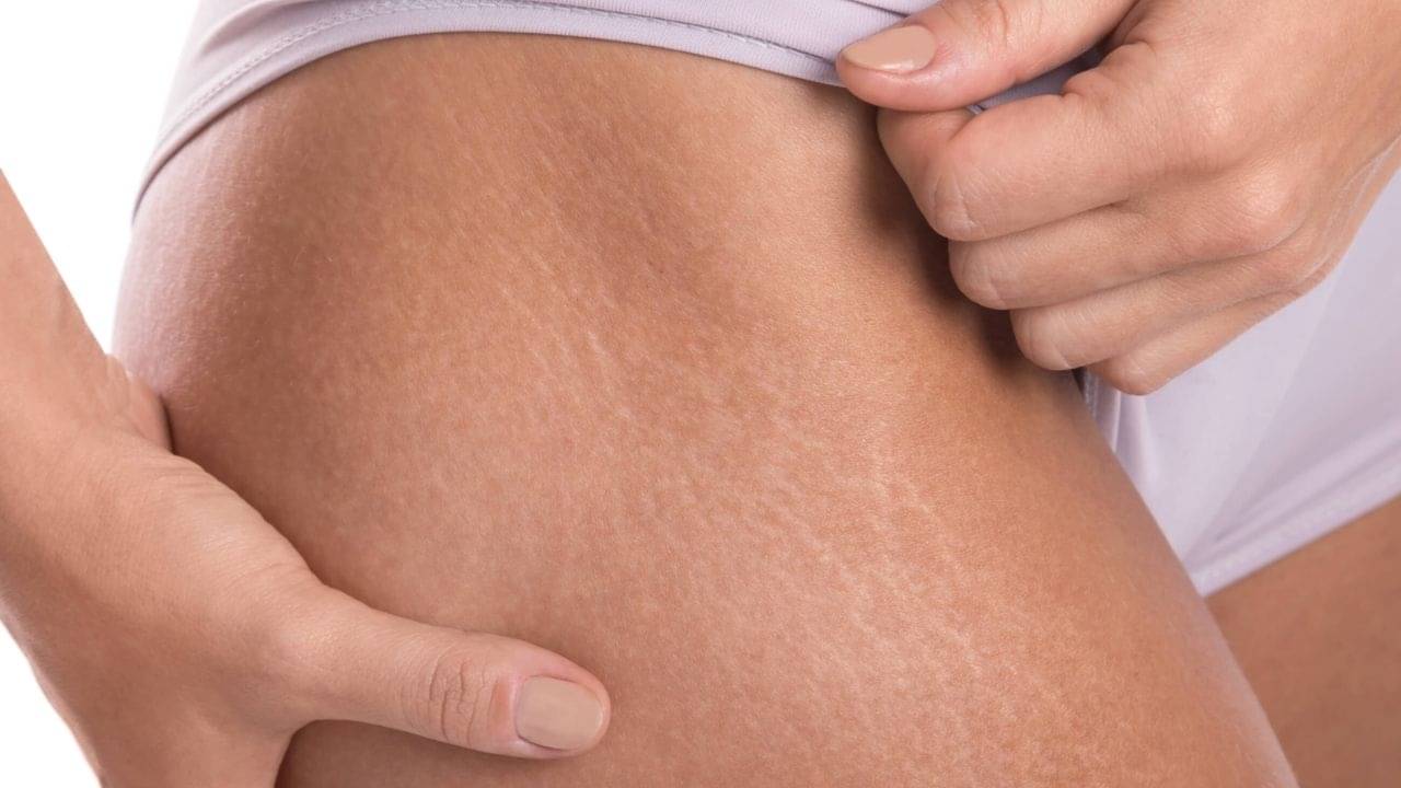 Skin Stretch Mark: ত্বকের স্ট্রেচ মার্ক থেকে মুক্তি পেতে এই ঘরোয়া উপায়গুলো নিয়ে দেখুন, উপকার মিলবেই...