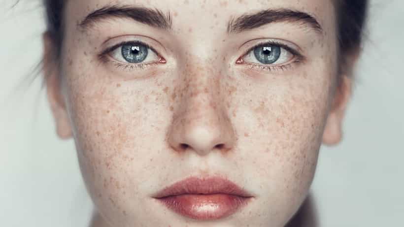 Freckles: কোনও ভাবেই নিয়ন্ত্রণ করতে পারছেন না ফ্রিকেলসের সমস্যাকে? বেছে নিন ঘরোয়া প্রতিকার