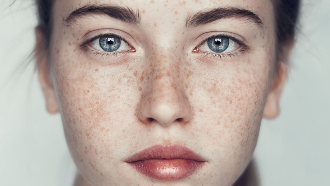 Freckles: কোনও ভাবেই নিয়ন্ত্রণ করতে পারছেন না ফ্রিকেলসের সমস্যাকে? বেছে নিন ঘরোয়া প্রতিকার
