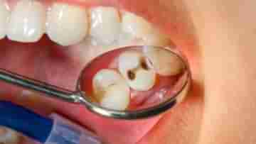 Tooth Cavity: দাঁতের ক্যাভিটি থেকে মুক্তি পেতে রয়েছে কিছু সহজ ও কার্যকরী ঘরোয়া উপায়!