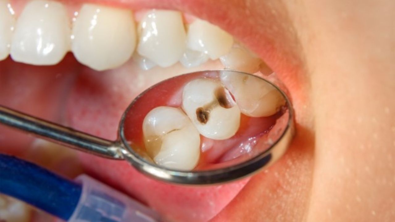 Tooth Cavity: দাঁতের ক্যাভিটি থেকে মুক্তি পেতে রয়েছে কিছু সহজ ও কার্যকরী ঘরোয়া উপায়!