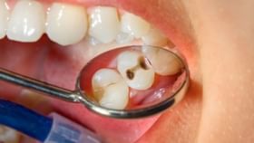Tooth Cavity: দাঁতের ক্যাভিটি থেকে মুক্তি পেতে রয়েছে কিছু সহজ ও কার্যকরী ঘরোয়া উপায়! Tooth Cavity: দাঁতের ক্যাভিটি থেকে মুক্তি পেতে রয়েছে কিছু সহজ ও কার্যকরী ঘরোয়া উপায়!