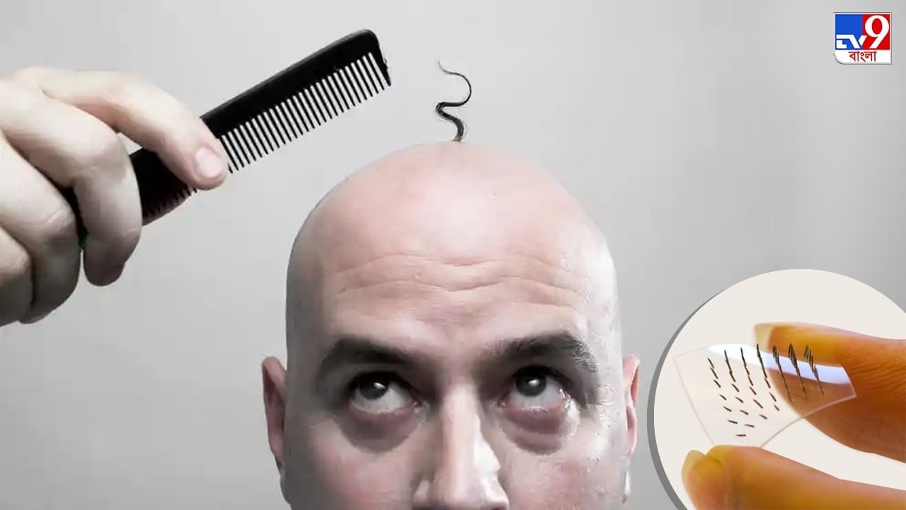 Male Baldness Treatment: Scientists are amazed at the technical solution of hair  growth, micronidol patch theory! | Using A Microneedle Patch Scientists  Came Across An Effective Treatment For Male Baldness | PiPa News