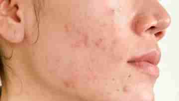 Acne Scars: ব্রণর দাগ দূর করা সহজ কাজ নয়! টানা একমাস এই ফেসপ্যাক ব্যবহার করে নিজেই পার্থক্য দেখুন