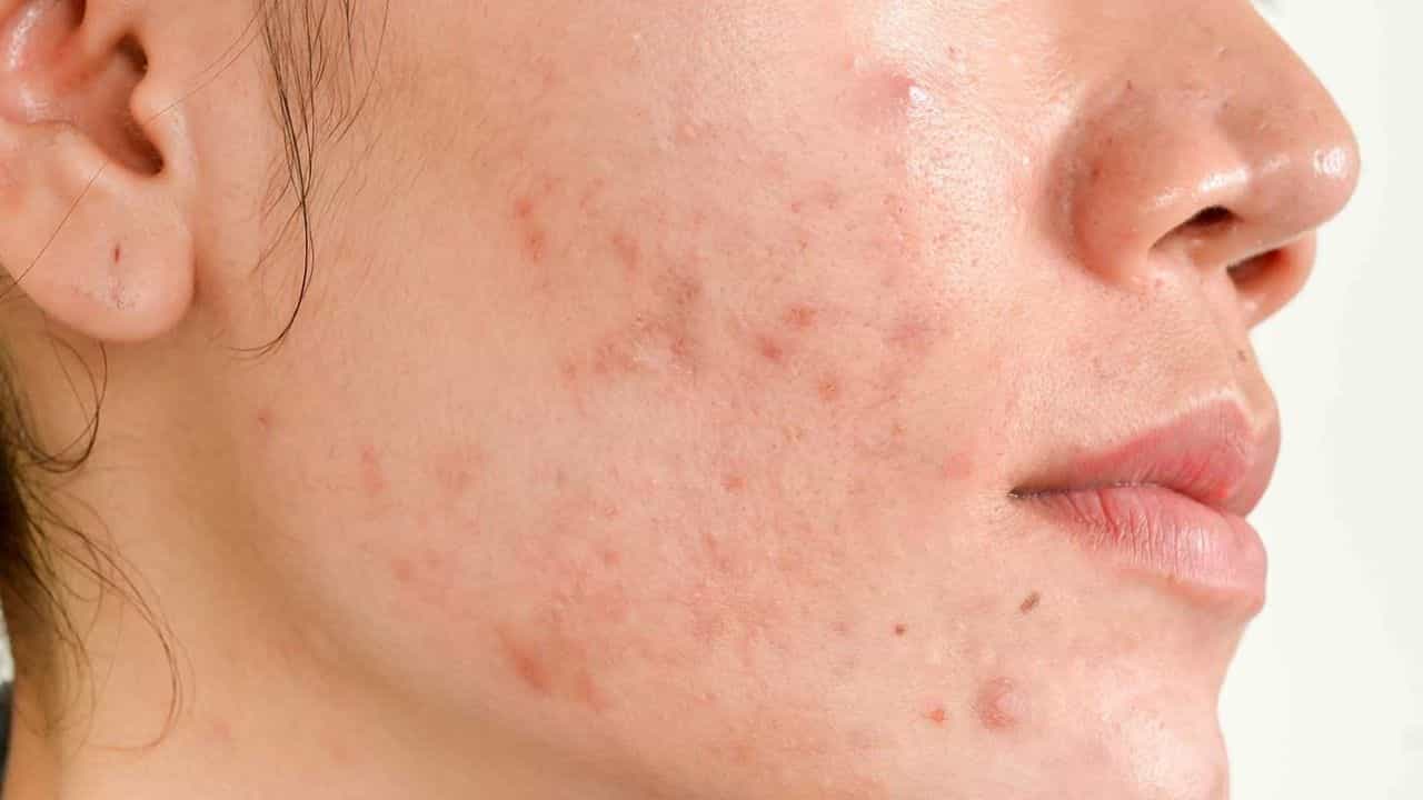 Acne Scars: ব্রণর দাগ দূর করা সহজ কাজ নয়! টানা একমাস এই ফেসপ্যাক ব্যবহার করে নিজেই পার্থক্য দেখুন Acne Scars: ব্রণর দাগ দূর করা সহজ কাজ নয়! টানা একমাস এই ফেসপ্যাক ব্যবহার করে নিজেই পার্থক্য দেখুন
