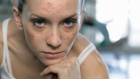Adult Acne: বয়স বাড়লেও ব্রণর সমস্যা পিছু ছাড়চ্ছে না? এর পিছনে কোন কারণগুলি দায়ী, জেনে নিন Adult Acne: বয়স বাড়লেও ব্রণর সমস্যা পিছু ছাড়চ্ছে না? এর পিছনে কোন কারণগুলি দায়ী, জেনে নিন