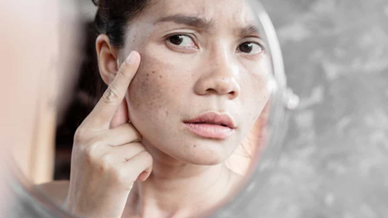 Skin Pigmentation: ত্বকের উপর কালো ছোপ হঠাতে মেনে চলুন এই ৫ ঘরোয়া টিপস