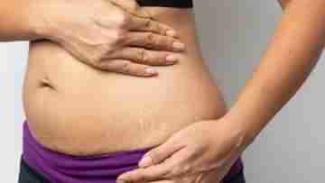 Stretch Marks: স্ট্রেচ মার্ক দূর করতে শিয়া বাটার কি কার্যকর? কীভাবে ব্যবহার করবেন এই উপাদানটি