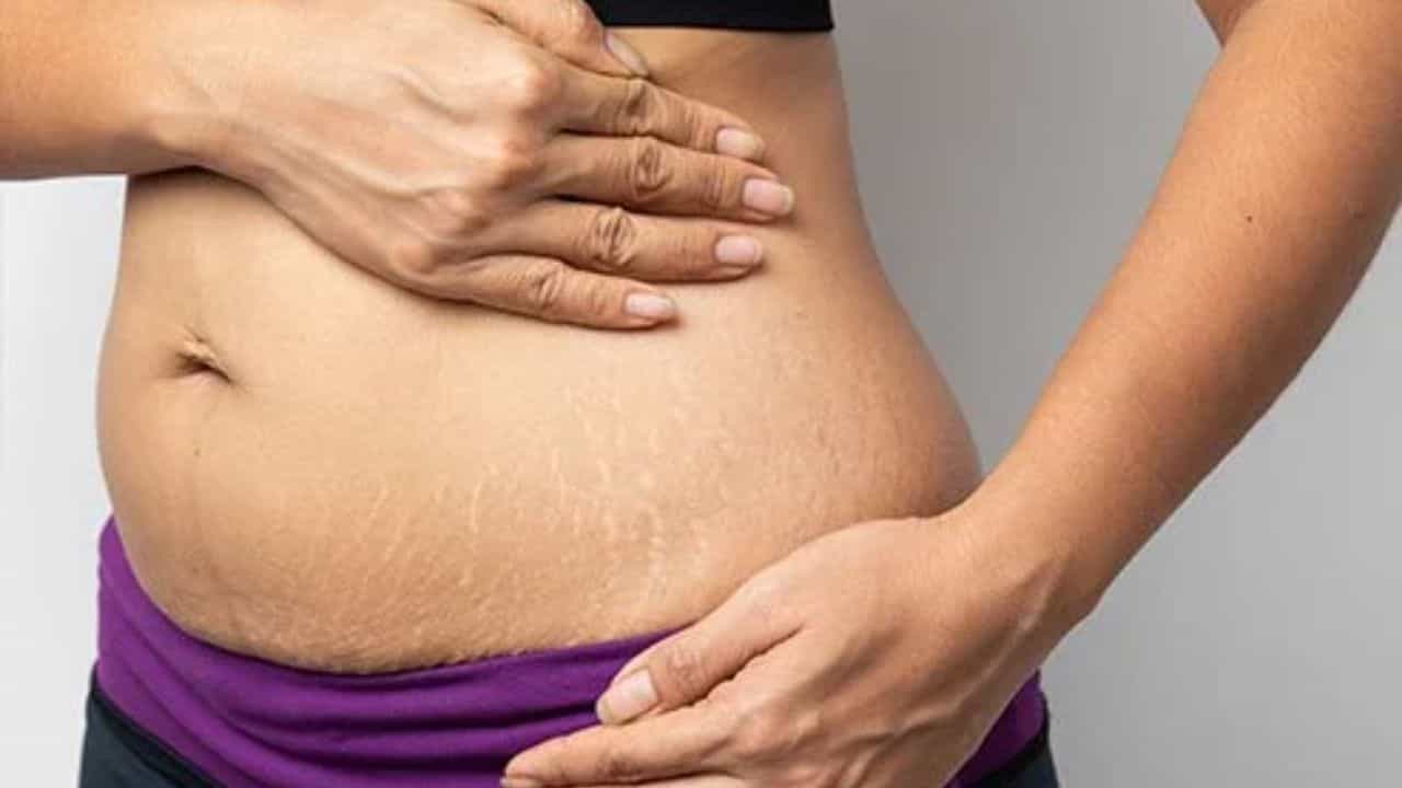 Stretch Marks: স্ট্রেচ মার্ক দূর করতে শিয়া বাটার কি কার্যকর? কীভাবে ব্যবহার করবেন এই উপাদানটি Stretch Marks: স্ট্রেচ মার্ক দূর করতে শিয়া বাটার কি কার্যকর? কীভাবে ব্যবহার করবেন এই উপাদানটি