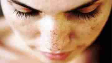 Facial Skin Care: নতুন গবেষণা থেকে জানা গেল ত্বকের যাবতীয় দাগ সারিয়ে তোলার এক দারুণ উপায়...