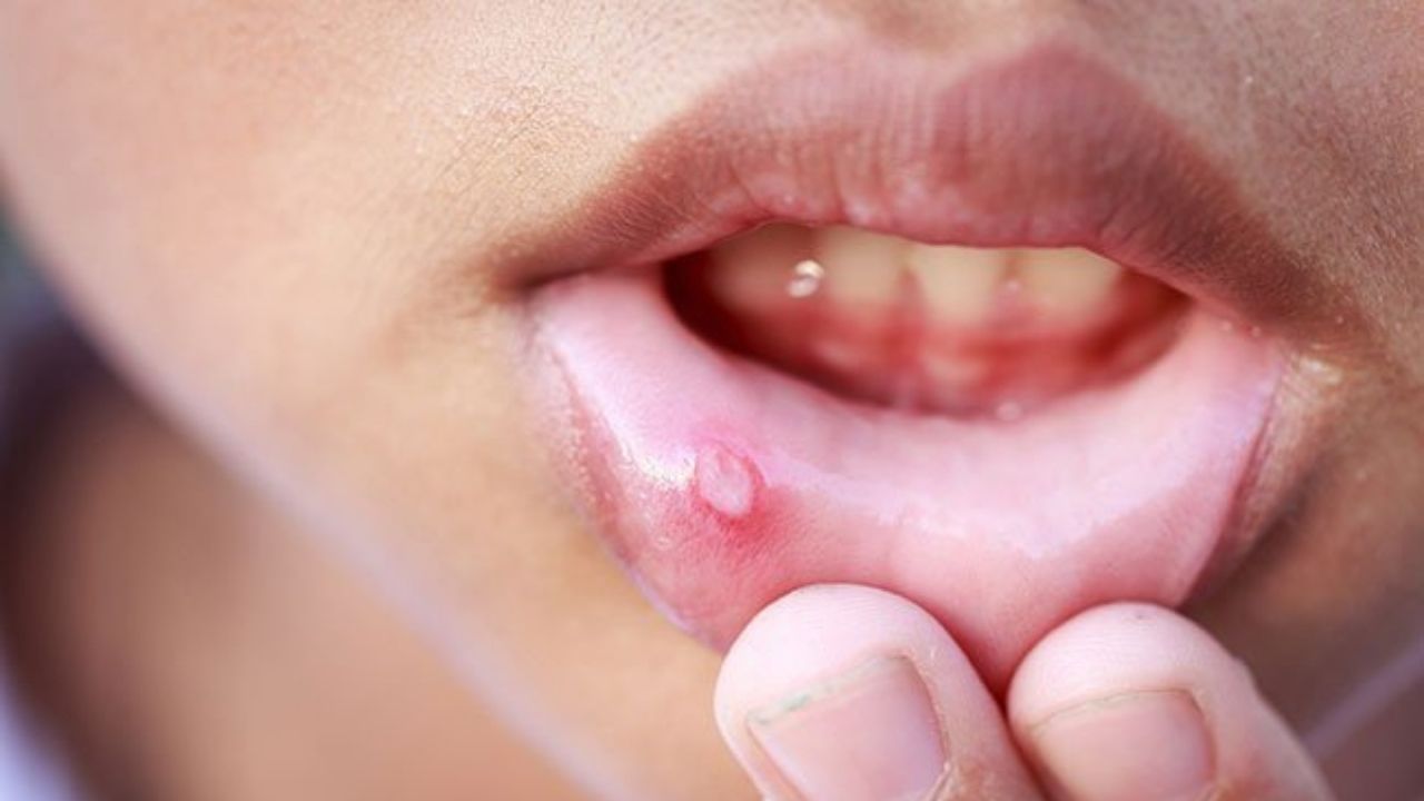 Mouth Ulcers: মুখের ভিতর দগদগে ঘা হয়েছে? আলসারের ক্ষত সারাতে অব্যর্থ এই ৫ ঘরোয়া টোটকাই যথেষ্ট