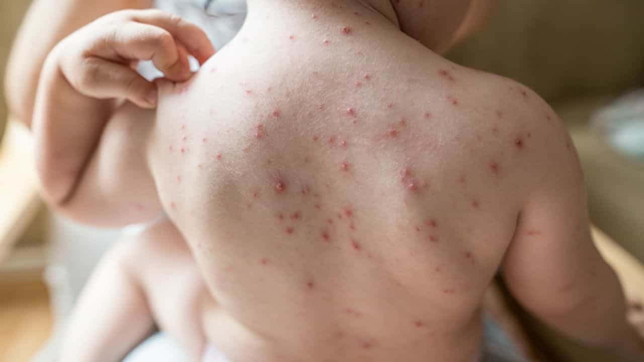 Chicken Pox: জলবসন্ত হলে 'মায়ের দয়া' হয়েছে বলা হয় কেন? করোনাভাইরাসেও দেবী শীতলা কি প্রাসঙ্গিক? Chicken Pox: জলবসন্ত হলে 'মায়ের দয়া' হয়েছে বলা হয় কেন? করোনাভাইরাসেও দেবী শীতলা কি প্রাসঙ্গিক?
