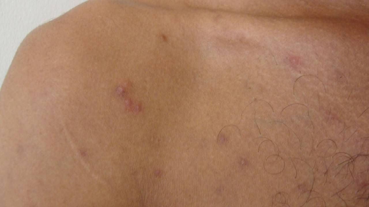 Tuberculosis: টিবি হলে কি ত্বকেও প্রভাব পড়ে?  শুনুন চিকিৎসকদের পরামর্শ