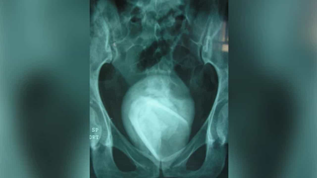 Tumbler In Bladder: তীব্র যৌন ইচ্ছাই হল কাল! মহিলার ব্লাডার থেকে এটা কী পাওয়া গেল? হতবাক সকলে Tumbler In Bladder: তীব্র যৌন ইচ্ছাই হল কাল! মহিলার ব্লাডার থেকে এটা কী পাওয়া গেল? হতবাক সকলে