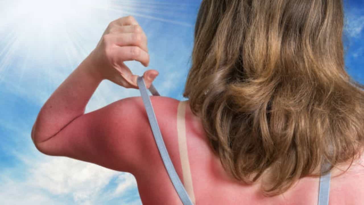 Sunburn: রোদে ঘুরে ঘুরে ত্বক পুড়ে গিয়েছে? সানবার্নের সমস্যা থেকে রেহাই পান ঘরোয়া উপায়ে Sunburn: রোদে ঘুরে ঘুরে ত্বক পুড়ে গিয়েছে? সানবার্নের সমস্যা থেকে রেহাই পান ঘরোয়া উপায়ে