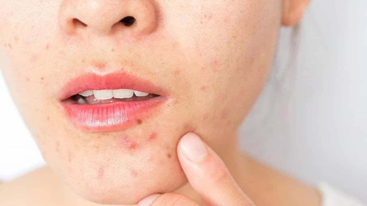 Skincare Routine: গরমে ব্রণর জ্বালায় অতিষ্ঠ? ত্বক পরিস্কার রাখতে প্রতিদিন মেনে চলুন এই ৯টি টিপস Skincare Routine: গরমে ব্রণর জ্বালায় অতিষ্ঠ? ত্বক পরিস্কার রাখতে প্রতিদিন মেনে চলুন এই ৯টি টিপস