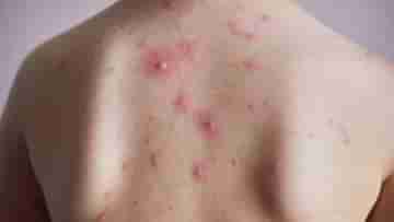 Back Acne: ঝলসানো রোদে পুড়ছে পিঠও! ব্যাকনের সমস্যাকে নিয়ন্ত্রণে রাখবেন কীভাবে?