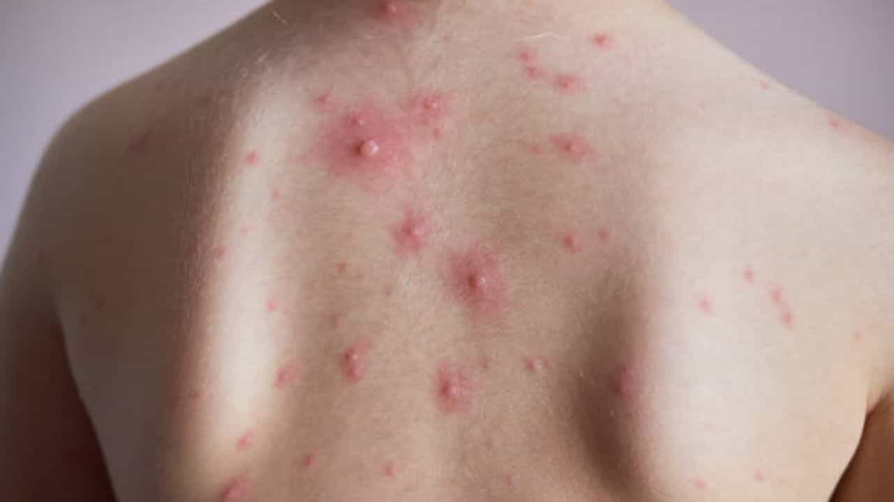 Back Acne: ঝলসানো রোদে পুড়ছে পিঠও! ব্যাকনের সমস্যাকে নিয়ন্ত্রণে রাখবেন কীভাবে? Back Acne: ঝলসানো রোদে পুড়ছে পিঠও! ব্যাকনের সমস্যাকে নিয়ন্ত্রণে রাখবেন কীভাবে?
