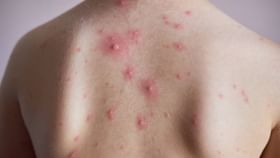 Back Acne: ঝলসানো রোদে পুড়ছে পিঠও! ব্যাকনের সমস্যাকে নিয়ন্ত্রণে রাখবেন কীভাবে? Back Acne: ঝলসানো রোদে পুড়ছে পিঠও! ব্যাকনের সমস্যাকে নিয়ন্ত্রণে রাখবেন কীভাবে?