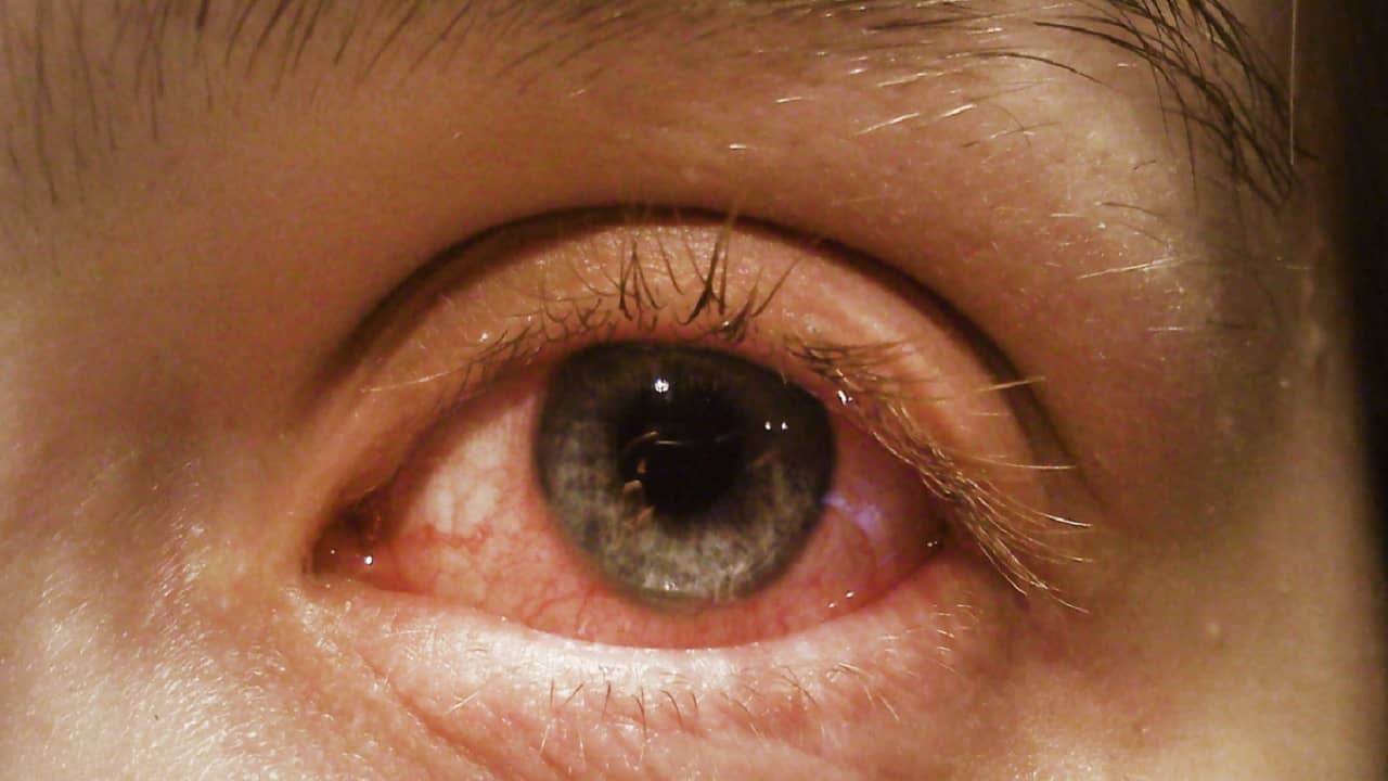 Coronavirus Infection: সাবধান! চোখ লাল, ব্যথাও কিন্তু হতে পারে করোনাভাইরাসের লক্ষণ...