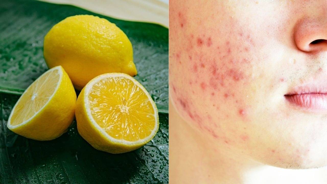 Acne Scars Treatment: সস্তায় পুষ্টিকর! কম খরচে ব্রণ-ফুসকুড়ির কালো দাগ উধাও হবে এক নিমেষেই