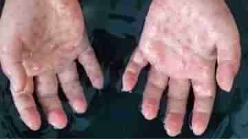 Monkeypox Outbreak: ইউরোপ ও উত্তর আমেরিকায় উদ্বেগের সঙ্গে বাড়ছে মাঙ্কিপক্স, জরুরি বৈঠকে WHO