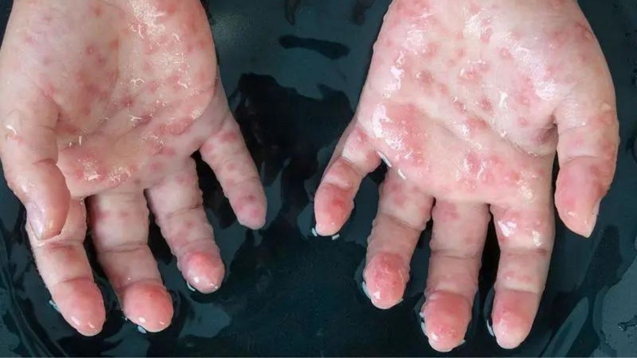 Monkeypox : আরও একটি দেশে মিলল মাঙ্কিপক্সের অস্তিত্ব, ক্রমেই ছড়িয়ে পড়ছে এই বিরল রোগ