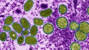Monkeypox Outbreak: কোভিডের মত অতিমারির রূপ নেবে মাঙ্কিপক্স! আতঙ্ক নয়, বিরল ভাইরাস থেকে বাঁচার ৫ উপায় জানাল CDC
