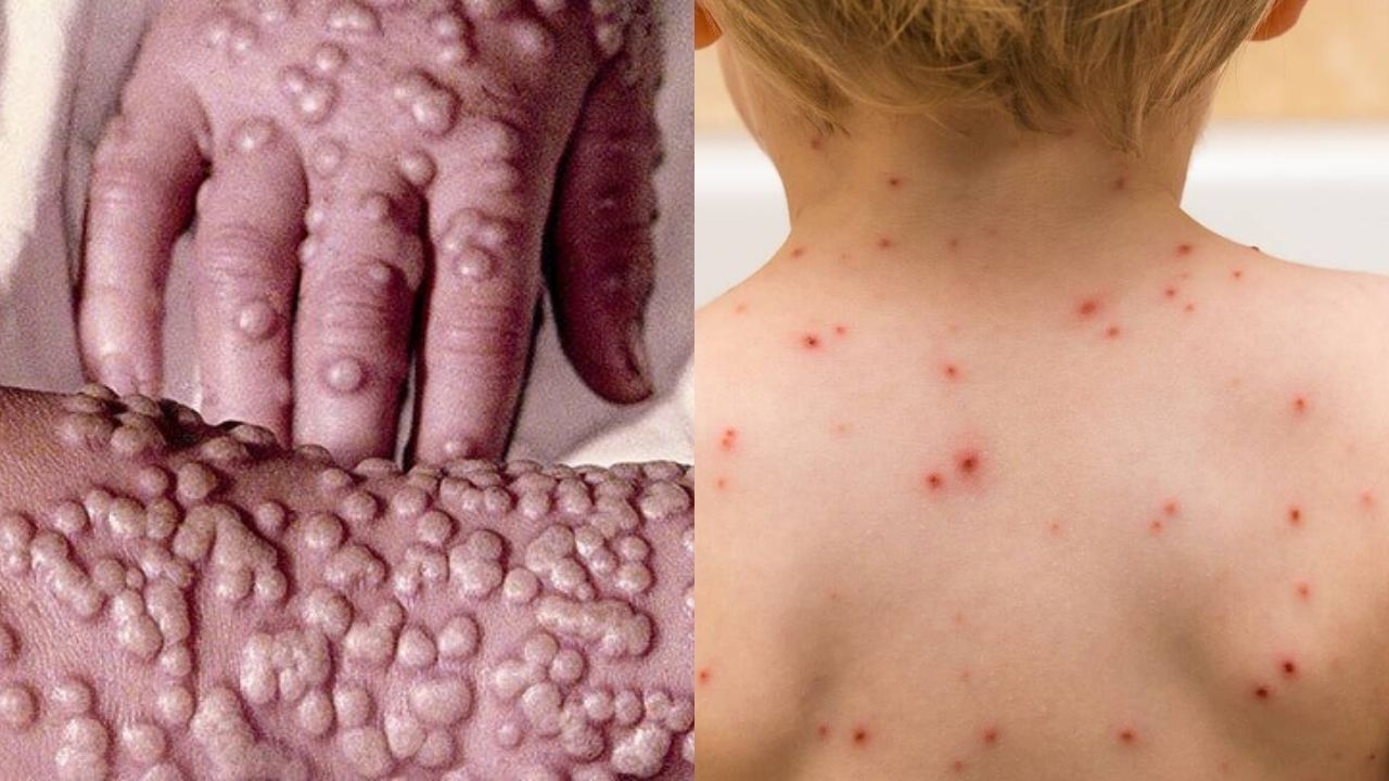 Monkeypox vs Smallpox: উদ্বেগ বাড়াচ্ছে মাঙ্কিপক্স! গুটিবসন্তের থেকে এই ভাইরাস কতটা আলাদা ও ভয়ংকর!