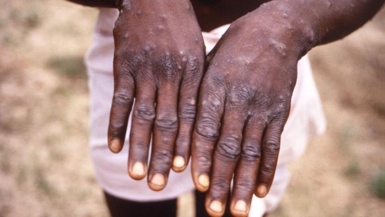 Monkeypox Virus : ফিরছে করোনার আতঙ্ক, এবার গোষ্ঠী সংক্রমণ মাঙ্কিপক্সের