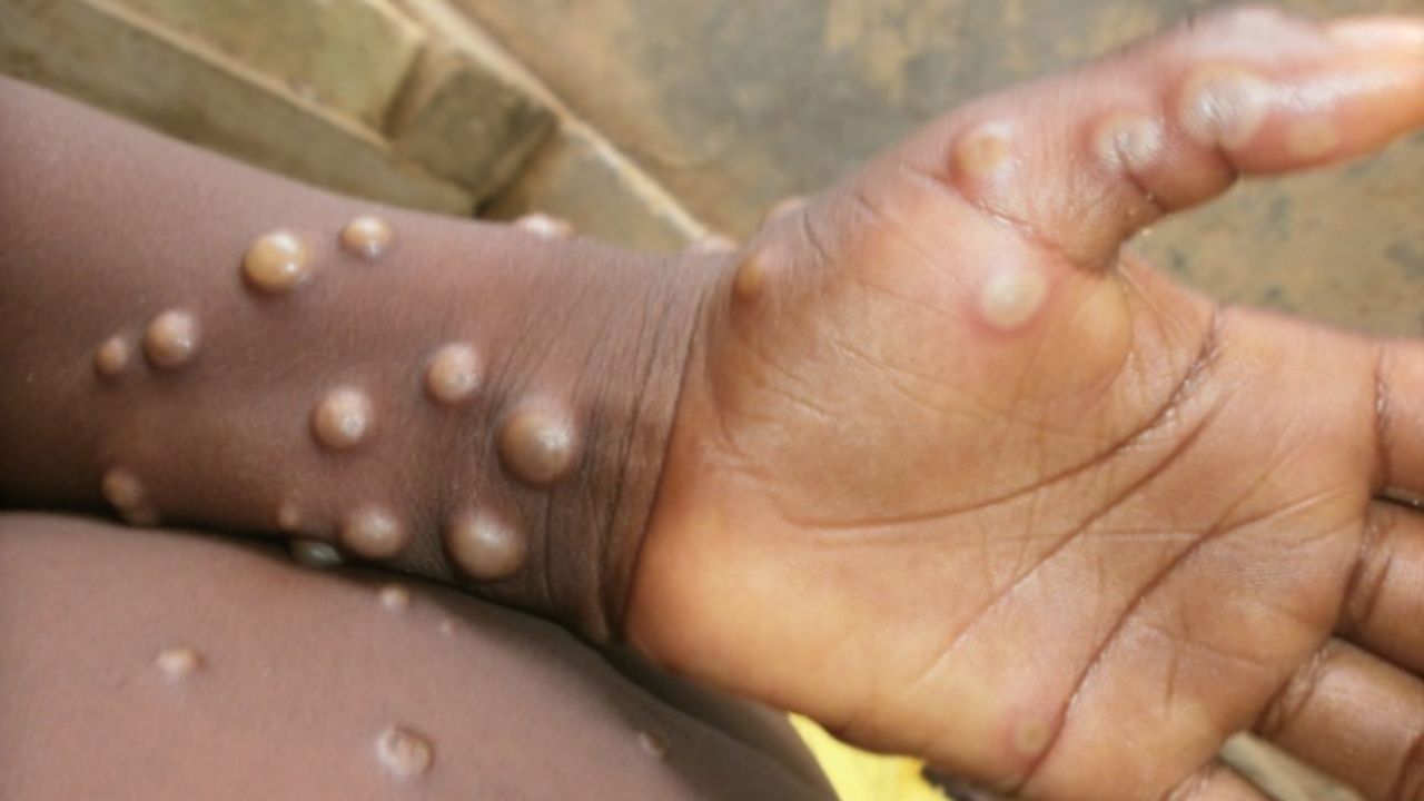 Monkeypox outbreak: মাঙ্কিপক্স নিয়ে আগাম সতর্ক ভারত! সন্দেহভাজনদের আইসোলেশনে রাখার পরামর্শ স্বাস্থ্য মন্ত্রকের