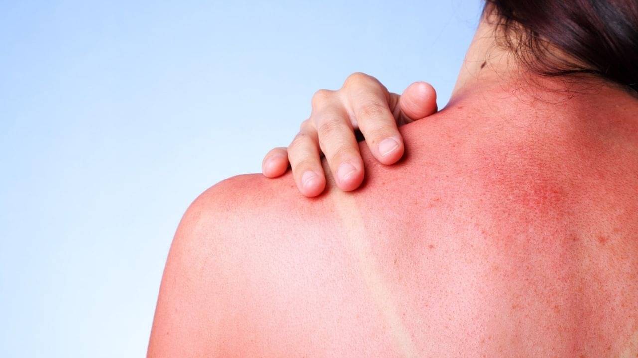 Sunburn: সানবার্ন আসলে কী? ত্বকের ক্যানসার ঠেকাতে মাথায় রাখুন জরুরি এই জিনিসগুলি