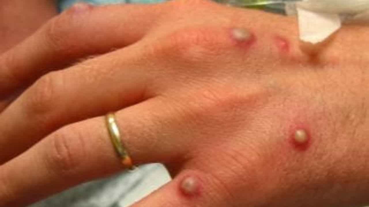 Monkeypox: আতঙ্কের আরেক নাম মাঙ্কিপক্স! বুঝবেন কীভাবে আপনি সংক্রমিত? Monkeypox: আতঙ্কের আরেক নাম মাঙ্কিপক্স! বুঝবেন কীভাবে আপনি সংক্রমিত?