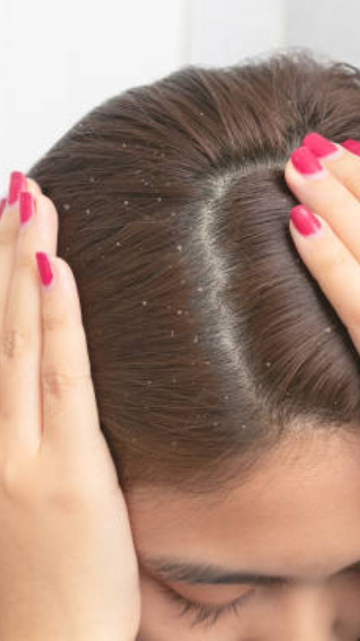 How to use rose water to get rid of dandruff