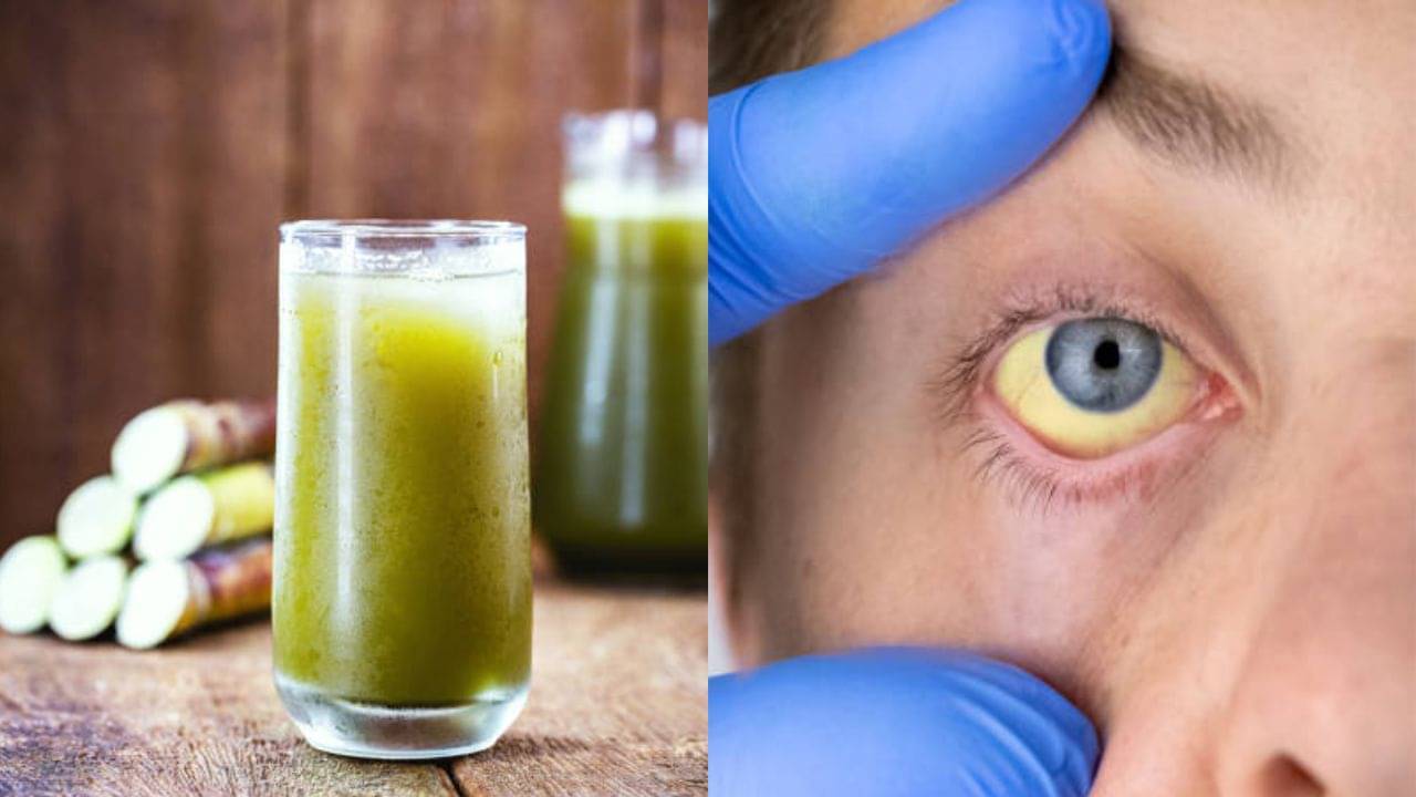 Jaundice: ওষুধ নয়, এই ৩ পানীয়তেই কমবে জন্ডিসের লক্ষণ!