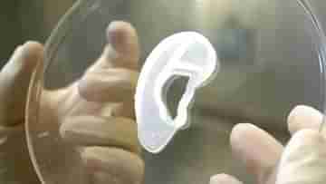3D-Printed Ear: এই প্রথম কোনও মহিলার থ্রিডি প্রিন্টেড কান বসল, তাঁর কোষ থেকে নিয়েই হল অসাধ্যসাধন