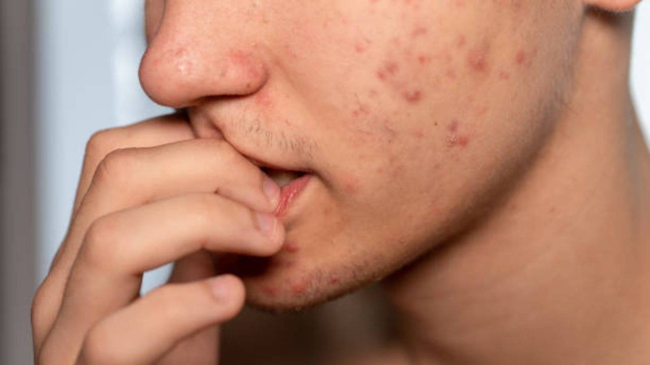 Teenage Acne Problem: বয়ঃসন্ধির ব্রণ ভোগাচ্ছে খুব? দাগ মেটাতে কী-কী করবেন, জেনে নিন