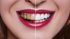 Teeth Health: বয়সের আগেই দাঁতে ক্ষয়? কোন পথে মিলবে সমাধান...