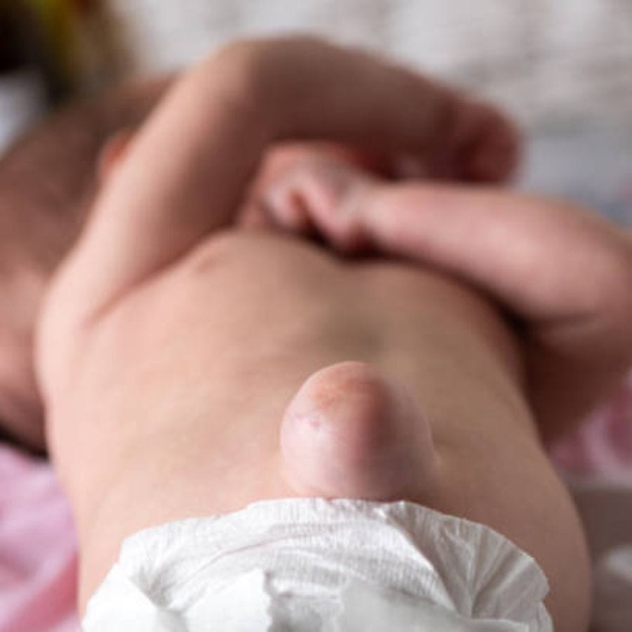 চিকিত্‍সা না করানো হলে হার্নিয়ার জটিলতা বেড়ে যায়। হার্নিয়া অপারেশন করে মুক্ত না হলে অন্ত্রের সমস্যা, এমনকি শ্বাসরোধের মতও ঘটনা ঘটতে পারে। হার্নিয়া অপারেশন ল্যাপারোস্কোপির মাধ্যমেই করা যায়। এই পদ্ধতিতে রক্তপাত, ব্যথা কম হয়, তেমনই রোগী দ্রুত সুস্থ হয়ে 