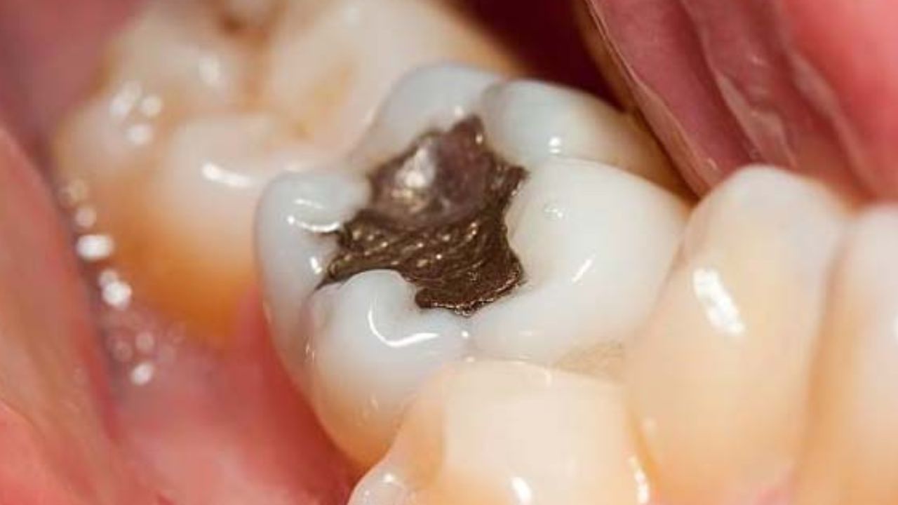 Tooth Cavity: ক্যাভিটি তাড়াতে আর ফিলিং নয়, রেহাই মিলবে এই ৩টি মোক্ষম ঘরোয়া দাওয়াইয়ে