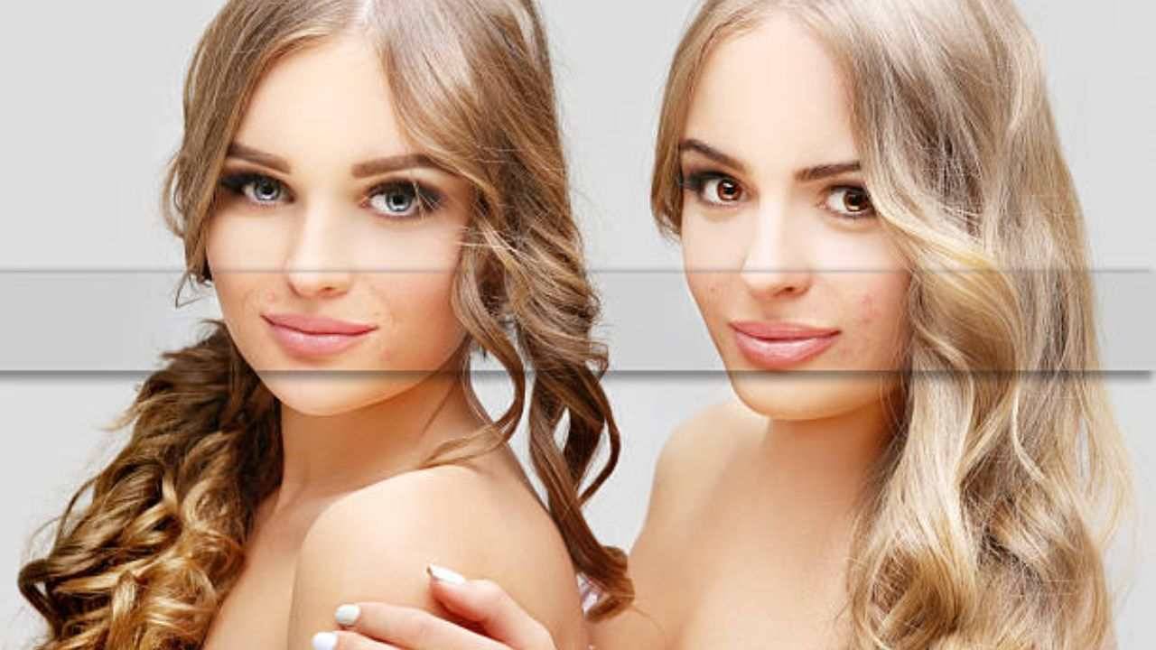 Mecheta: দাগ আচ্ছে হ্যায়, শরীরী খুঁত নিয়ে হীনম্নন্যতায় না ভুগে শুনুন বিশেষজ্ঞের টিপস...