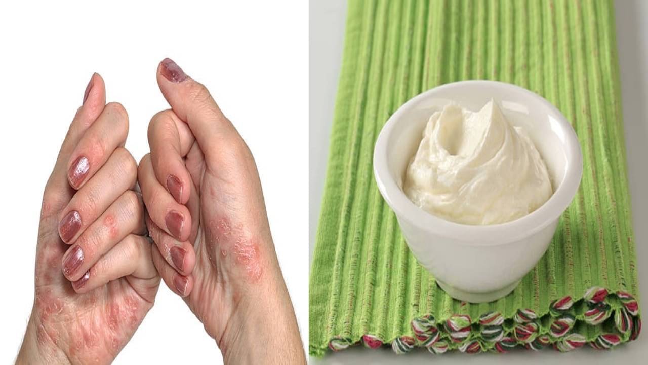 Skin Disease: ত্বক ভাল রাখতে কোন কোন খাবার এড়িয়ে যেতে বলছেন আর্য়ুবেদ বিশেষজ্ঞরা