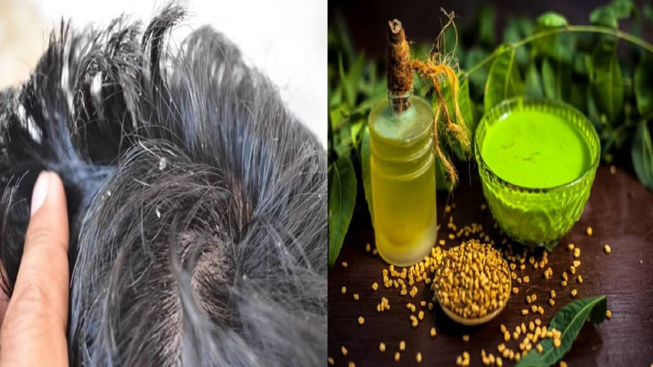 Dandruff Problem: সারা বছর খুশকির সমস্যায় ভোগেন? আয়ুর্বেদ মেনে চলুন ফল পাবেন হাতে-নাতে...